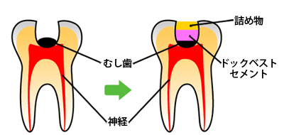 ドックベストセメント